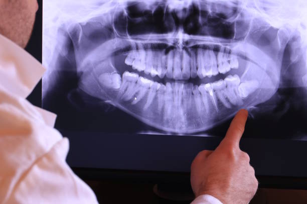 Best Emergency Wisdom Teeth Removal in Whitehall, WI